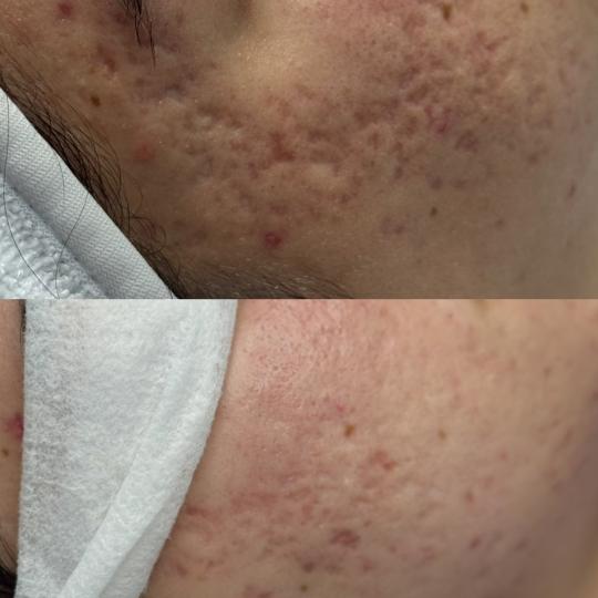 Hanas Skin Centar #banjaluka Tretman lica Microneedling tretman protiv ožiljaka od akni