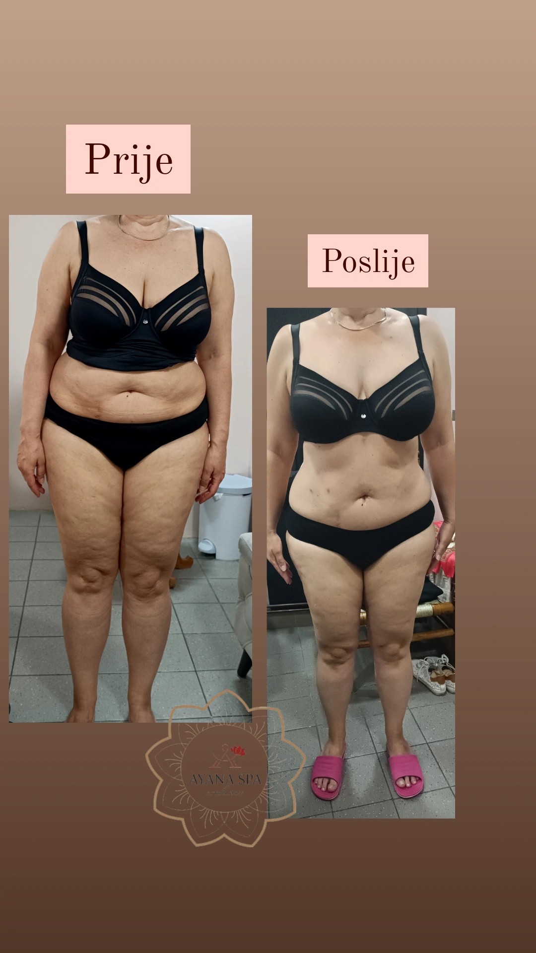 Ayana Spa #sarajevo Anticelulit masaža Anticelulit masaža