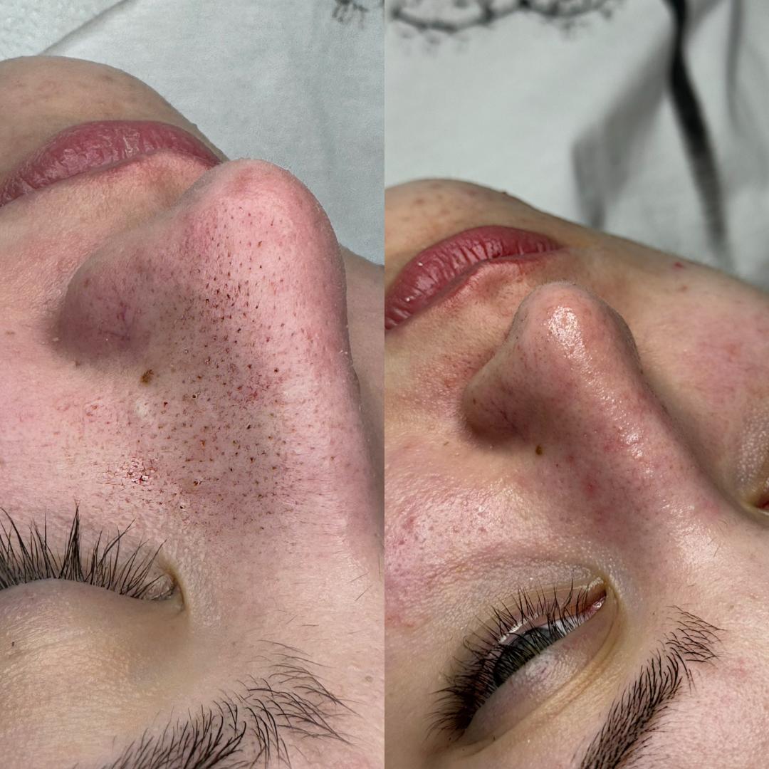 Hanas Skin Centar #banjaluka Air brush potamnjivanje kože Klasično higijensko čišćenje lica