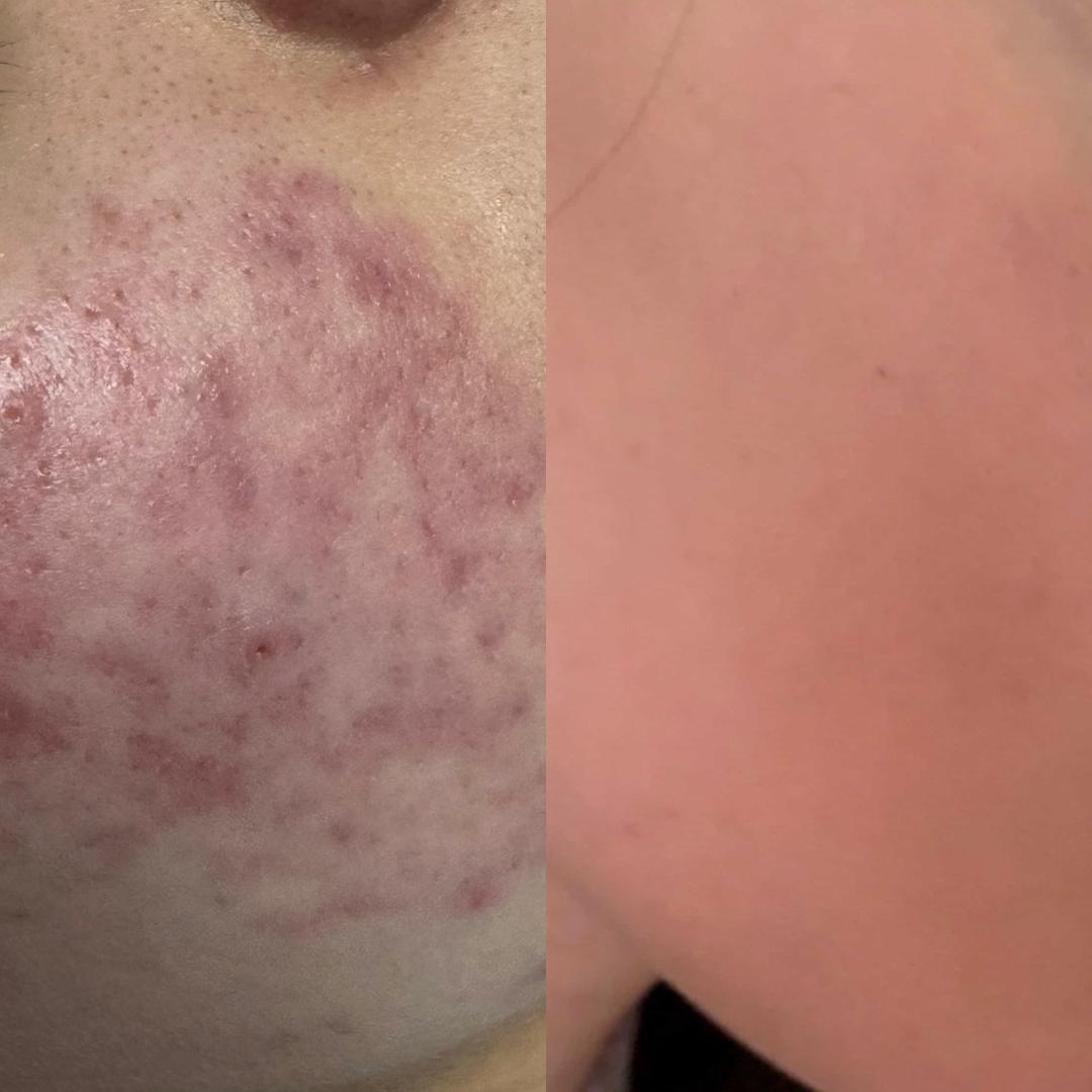 Hemijski piling - akne - Hanas Skin Centar, Banja Luka Tretman lica Lice Tretman lica, Banja Luka, Centar