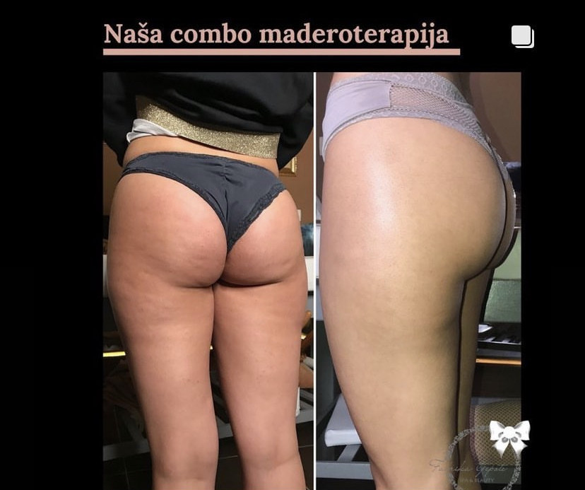 Combo S paket - maderoterapija cijelo tijelo - Fabrika ljepote, Sarajevo Anticelulit masaža Masaža Anticelulit masaža, Sarajevo, Istočno Sarajevo