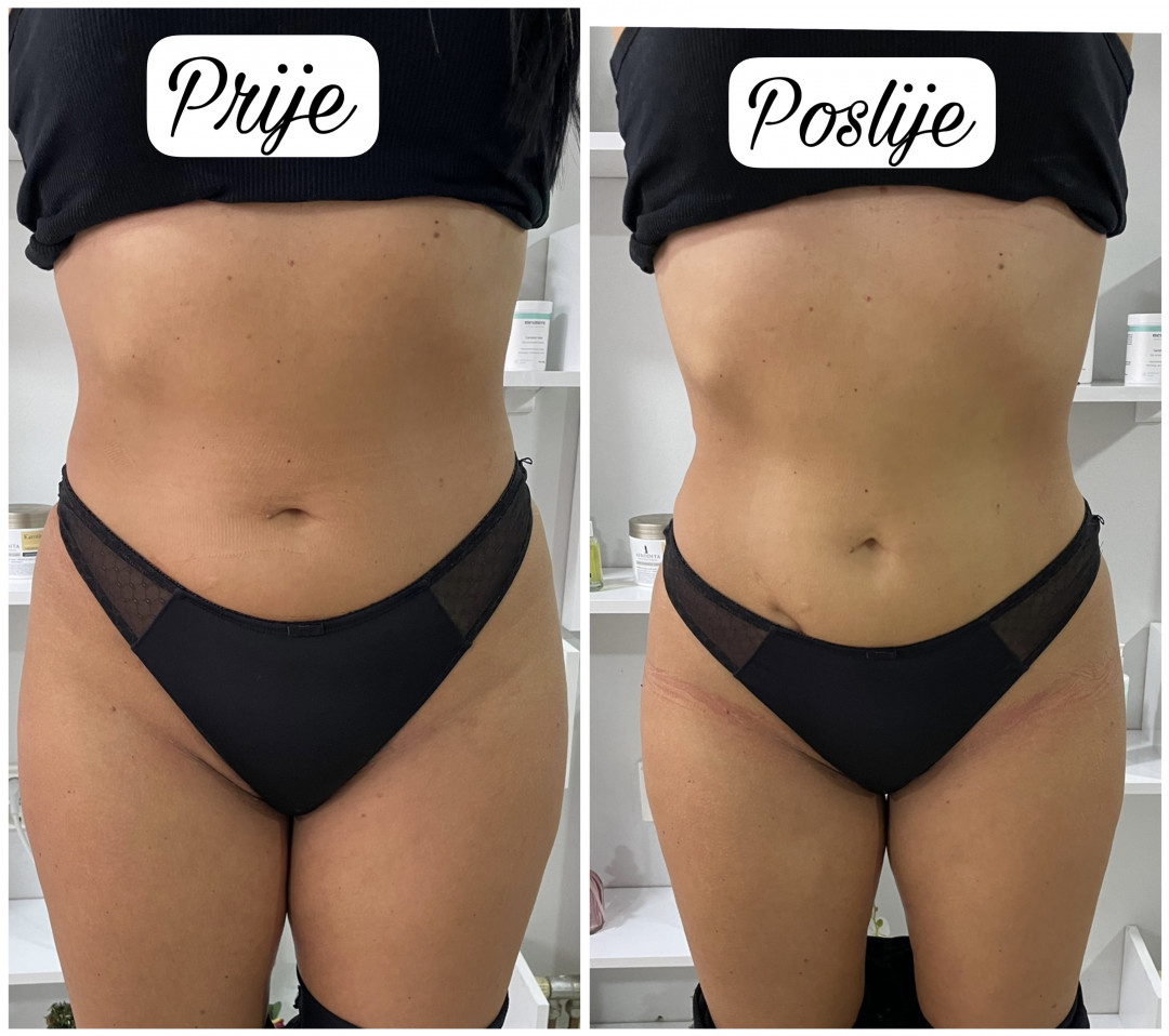 La Esthetique #sarajevo Tretman lica Hifu 7D - stomak