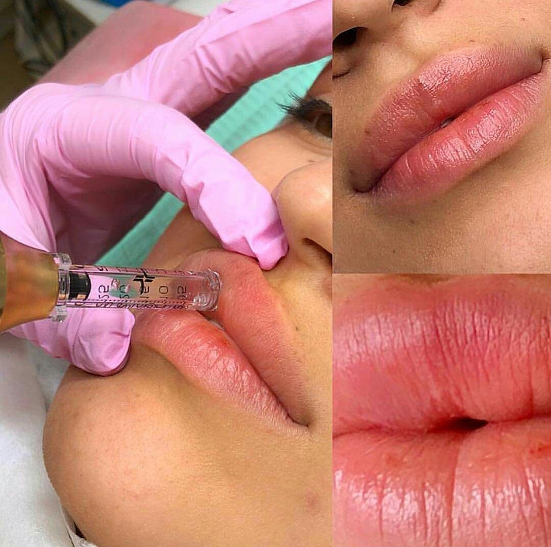 Signature #tuzla Tretmani protiv bora Edukacija - popunjavanje bora / povećanje volumena usana bez igle