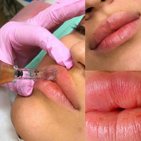 Signature #tuzla Tretmani protiv bora Edukacija - popunjavanje bora / povećanje volumena usana bez 