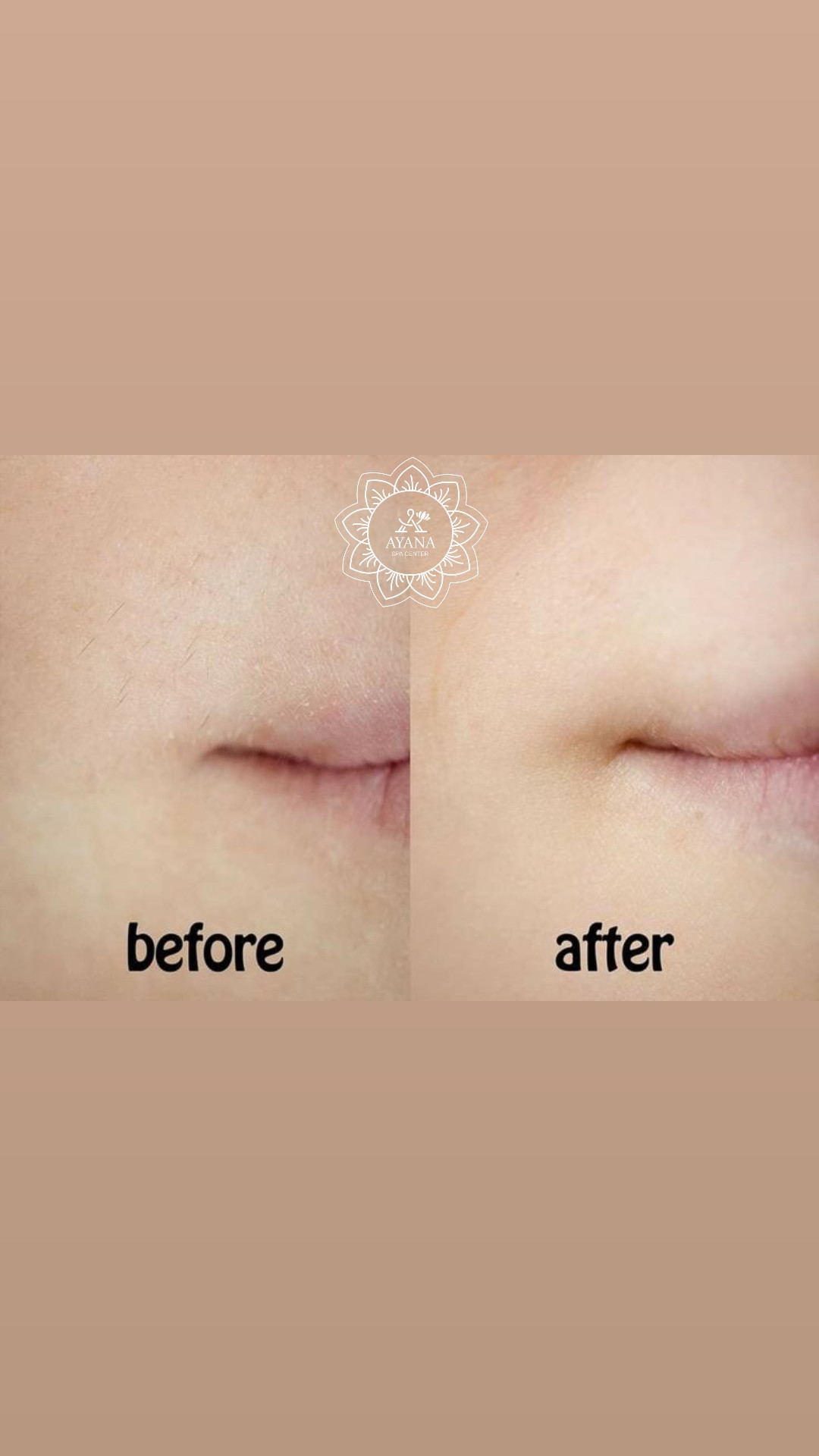 Ayana Spa #sarajevo Depilacija šećernom pastom Depilacija nausnica šećernom pastom - za dame