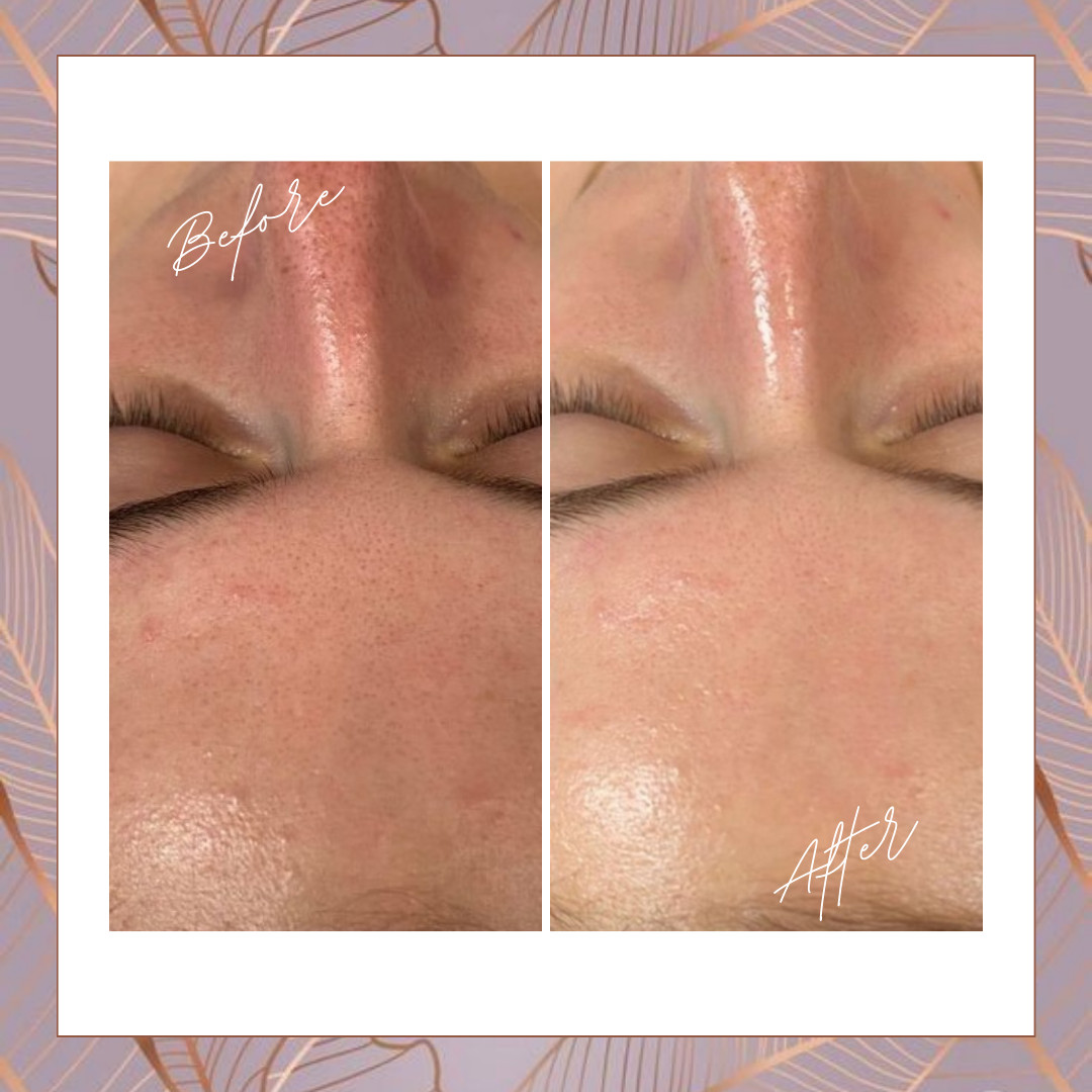 Beauty Studio Señorita #sarajevo Tretman lica Mikrodermoabrazija + Ultrazvučno hranjenje lica