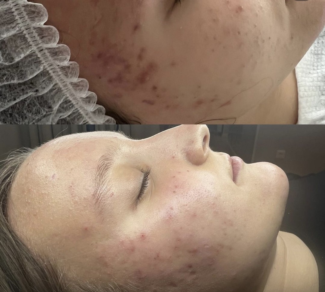 Dora Beauty #sarajevo Tretman lica HydraFacial tretman lica